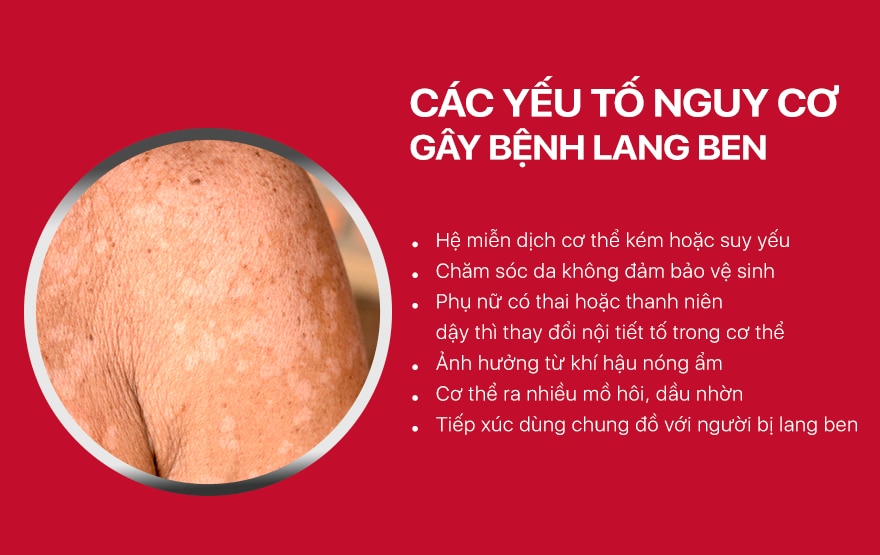 Cách Chẩn Đoán Bệnh Hắc Lào